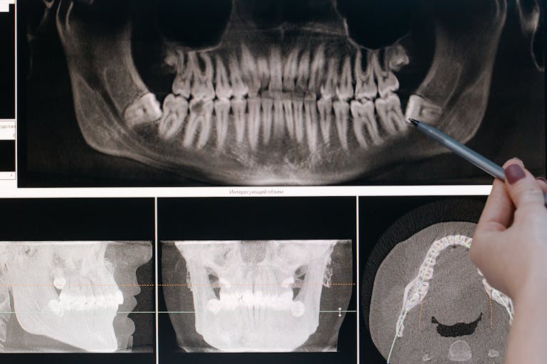 Wisdom teeth can be unpredictable, but staying informed and proactive is the best way to avoid unnecessary pain and dental issues.