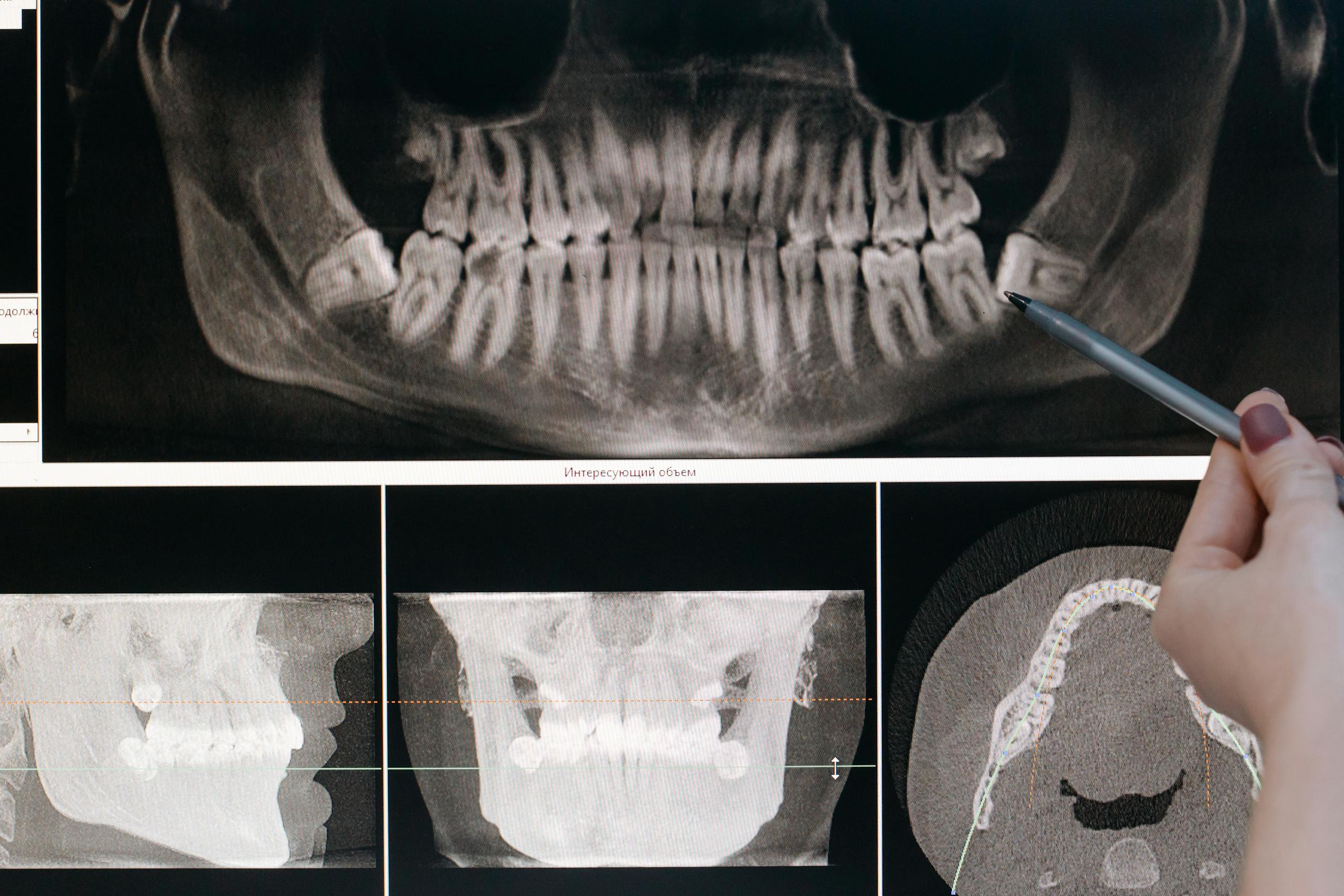 Wisdom teeth can be unpredictable, but staying informed and proactive is the best way to avoid unnecessary pain and dental issues.