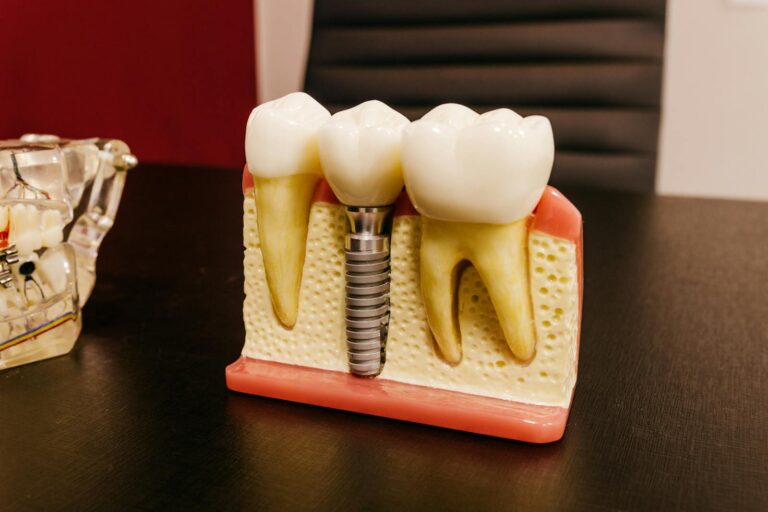 Illustration explaining how long dental implants last and how proper care extends their durability.