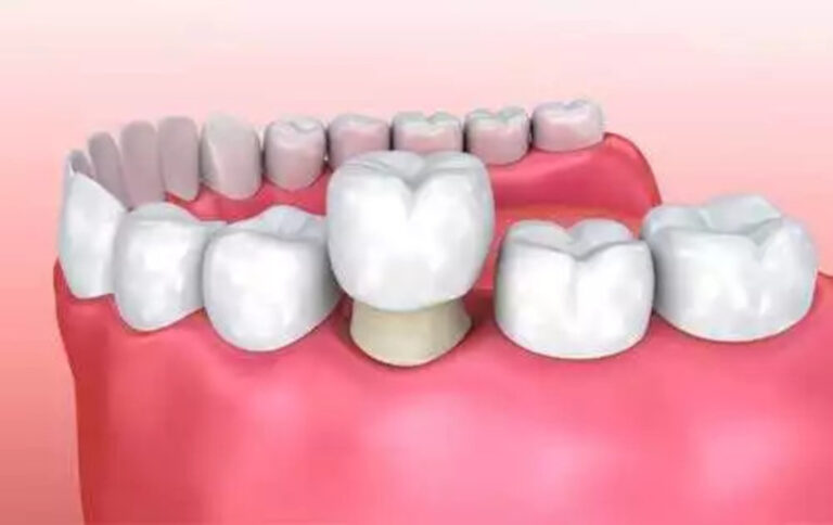 symptoms and reasons why a dental crown may feel loose or sensitive.