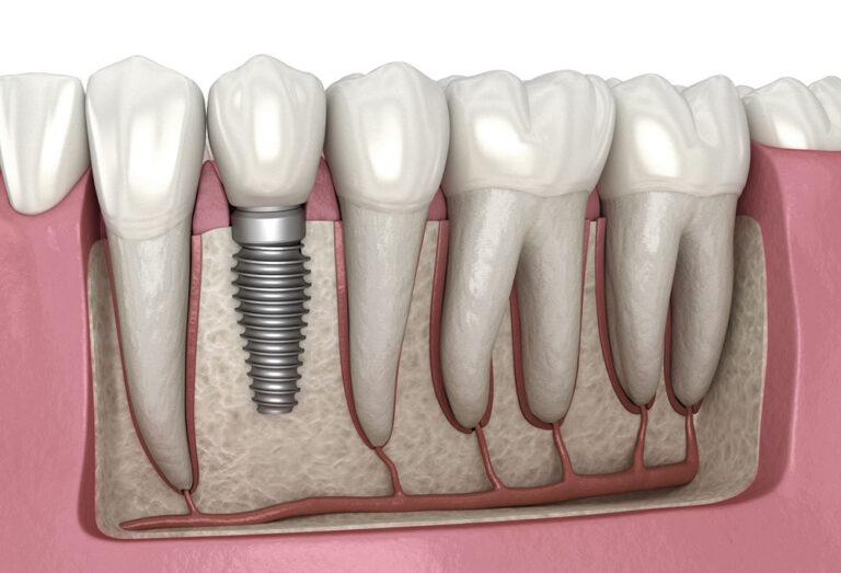 Visual showing how dental implants mimic the look and feel of real teeth once fully healed.