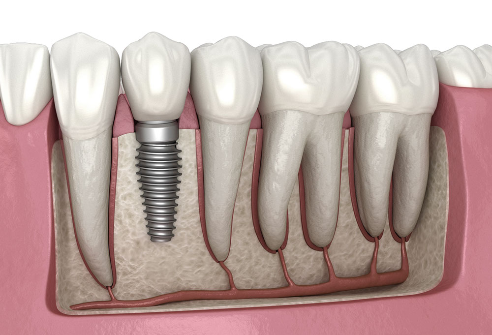 Visual showing how dental implants mimic the look and feel of real teeth once fully healed.