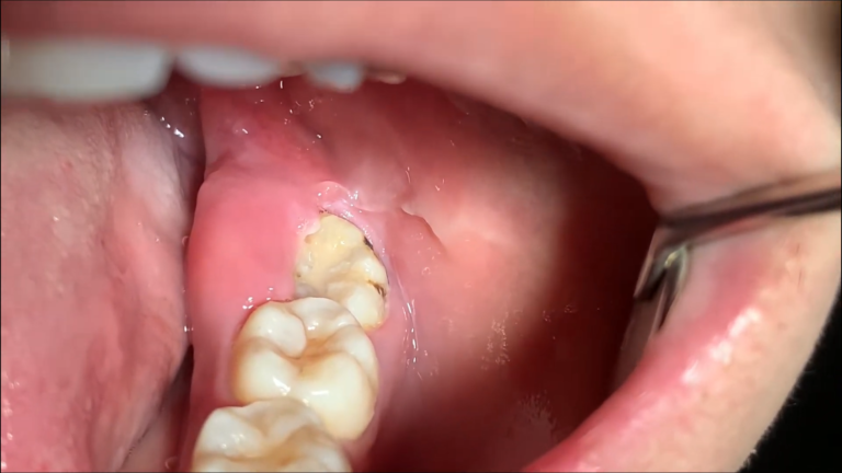 Illustration showing home remedies for reducing wisdom tooth swelling, including cold compress and saltwater rinse.