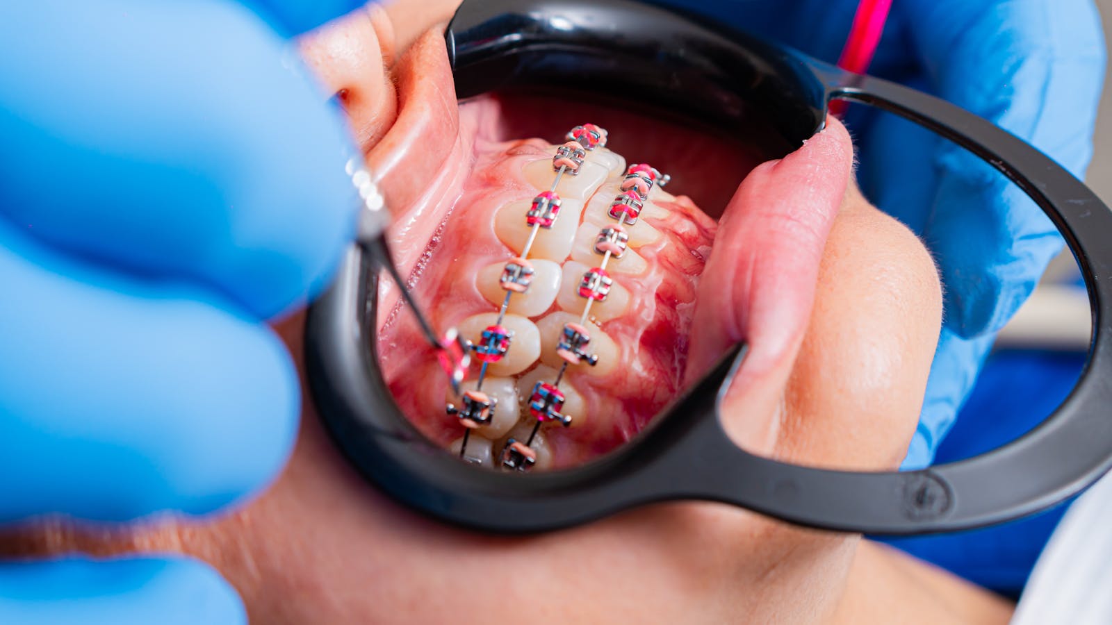 how wisdom teeth can contribute to front teeth crowding by exerting pressure on adjacent molars.