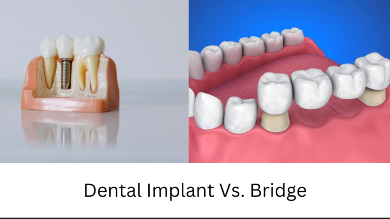 Illustration showing pros and cons of dental implants versus dental bridges for tooth replacement.