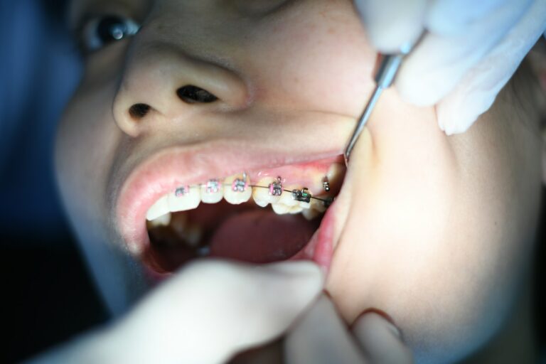 Illustration showing how orthodontic braces gradually move teeth into proper alignment over time.