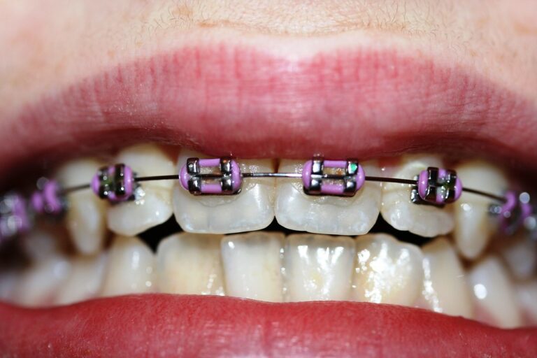 Illustration showing how orthodontic treatment can prevent wisdom tooth impaction by creating space in the jaw