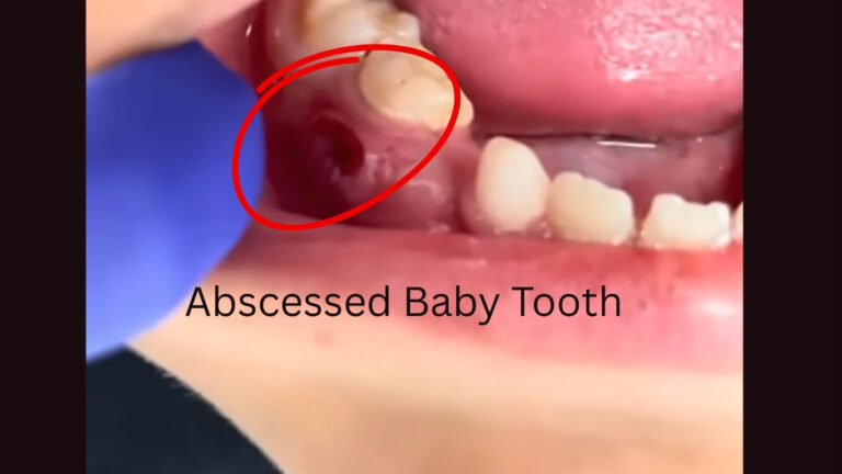 Child with swollen cheek due to an abscessed baby tooth