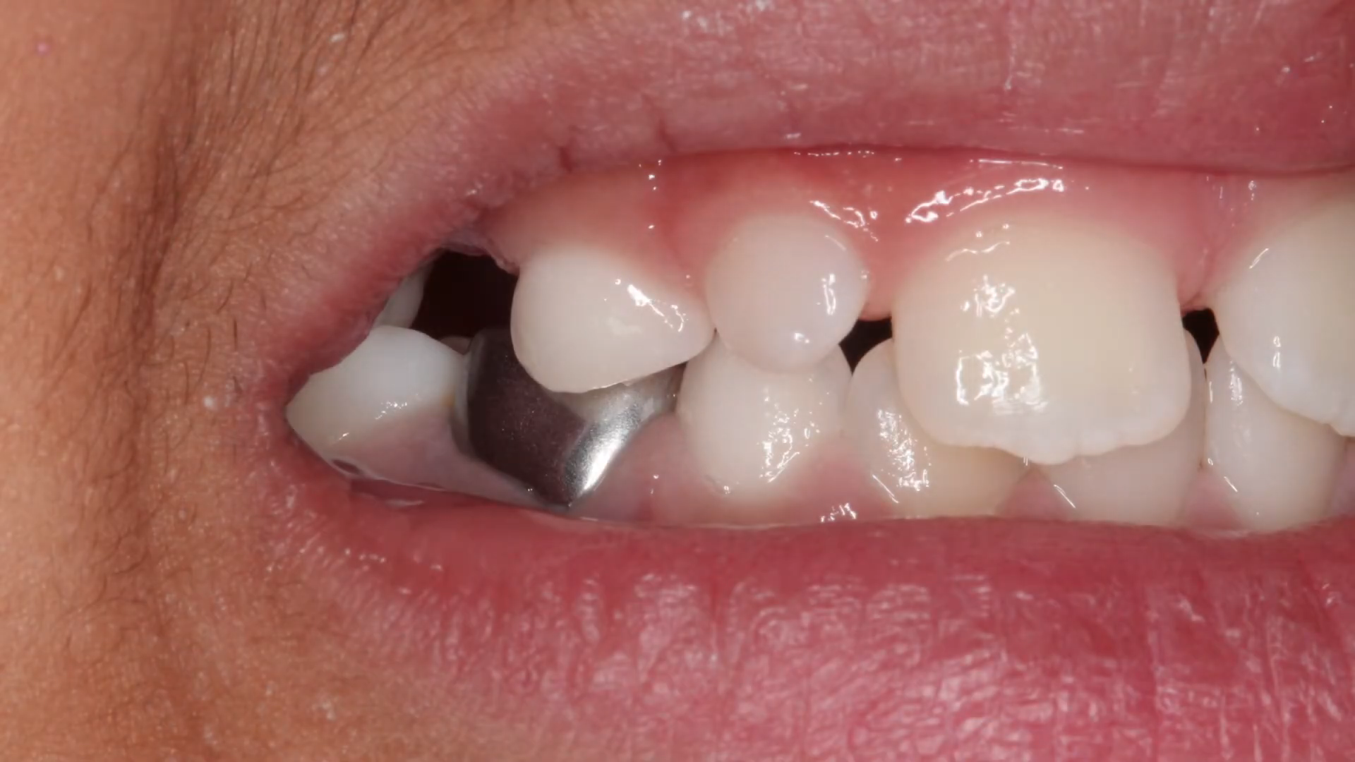 Child receiving a stainless steel crown on a baby tooth at a pediatric dental clinic
