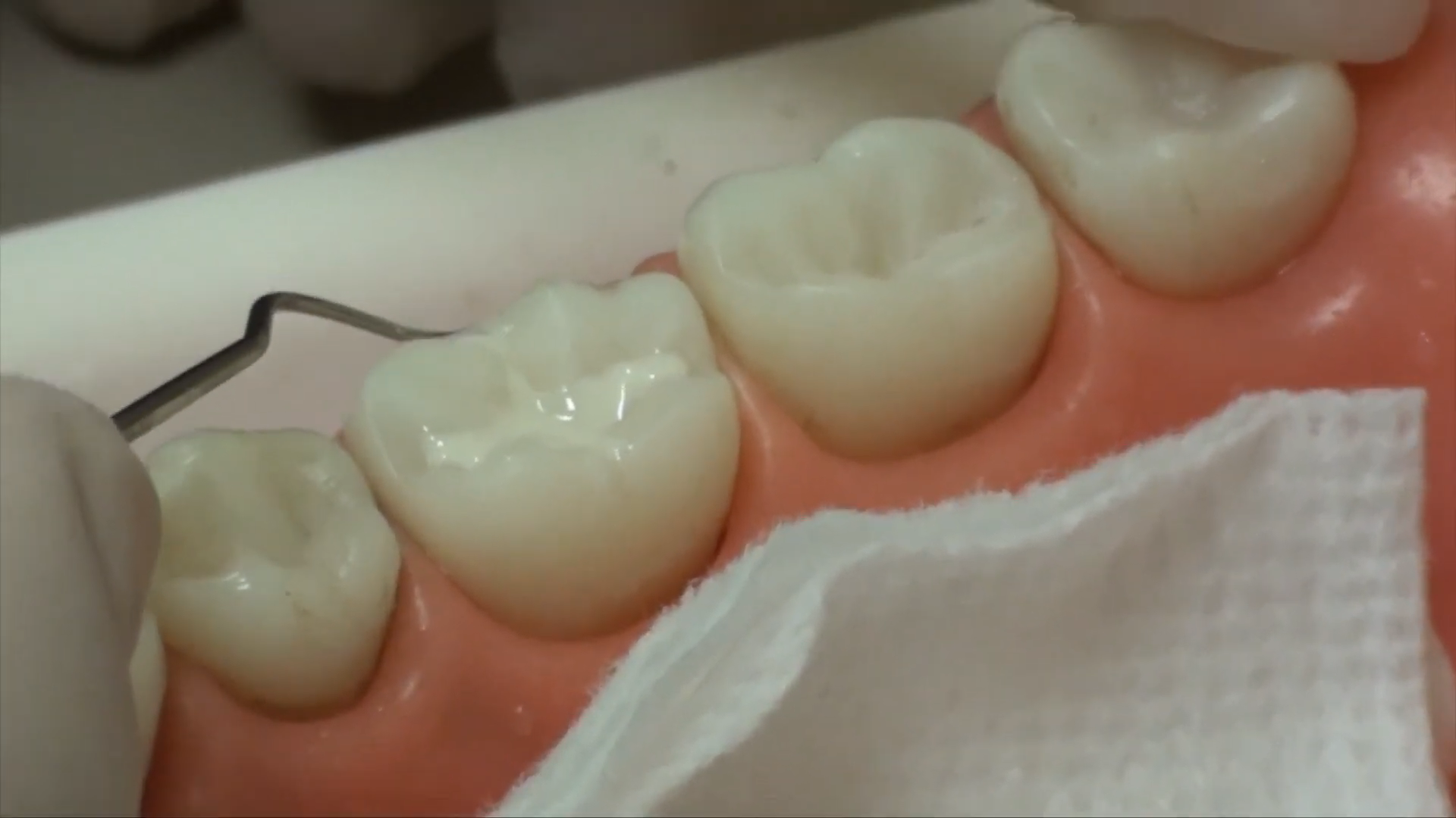 Pediatric dentist applying dental sealant to a child’s baby molar tooth